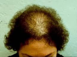 Movehs - Alopecia Androgenetica bij vrouwen